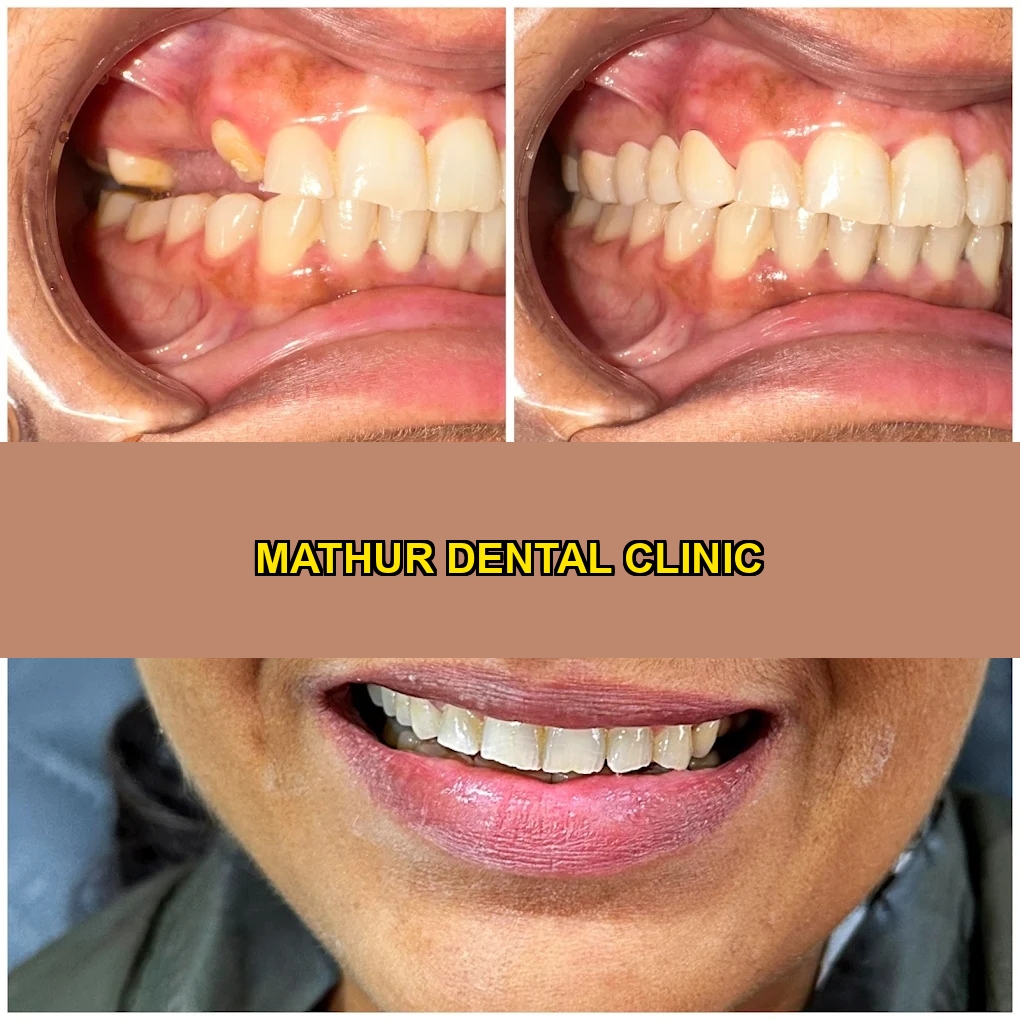 Dental implant and molar crown restoration before and after at Mathur