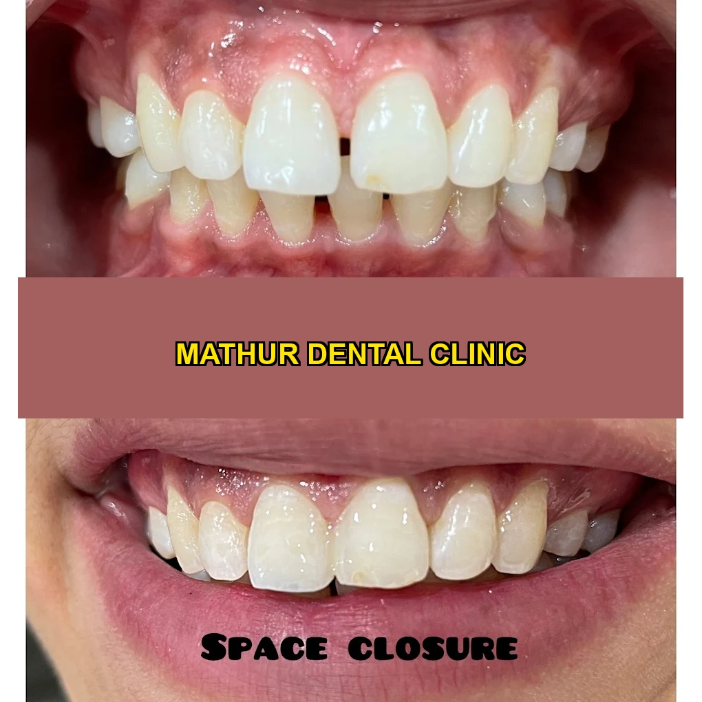 Space Closure cosmetic align before and after dental treatment at Mathur